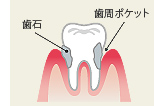 歯周炎(中等度)