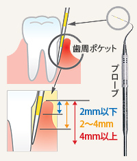 歯周ポケット検査（プローピング）