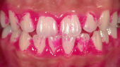 歯垢の染色